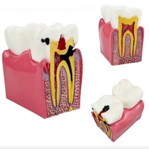 Tooth Decay