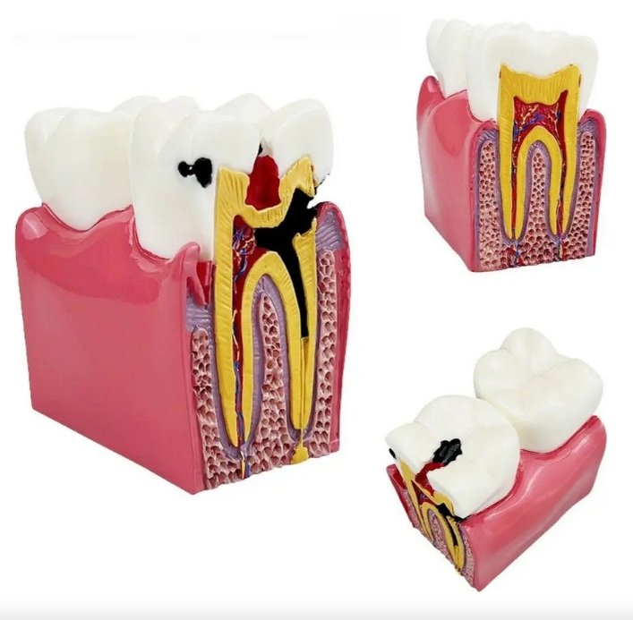 Tooth Decay