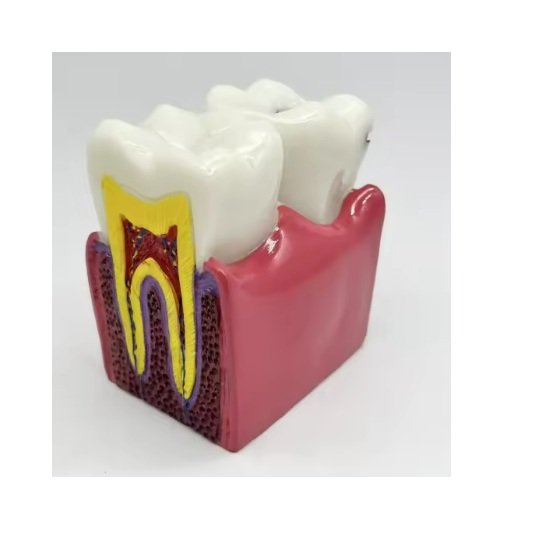 Tooth Decay