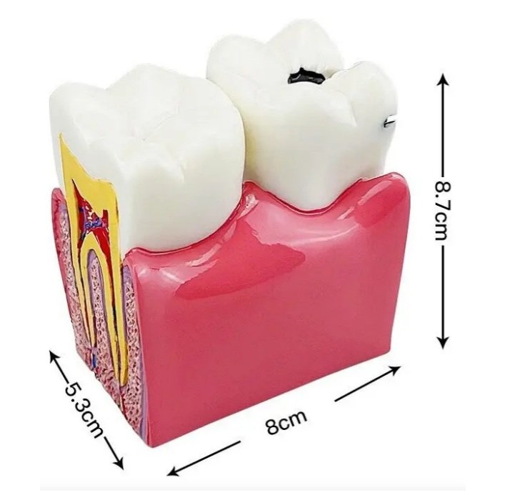 Tooth Decay