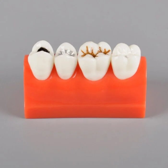 Dental Caries Model | Tooth Decay & Demonstration Model