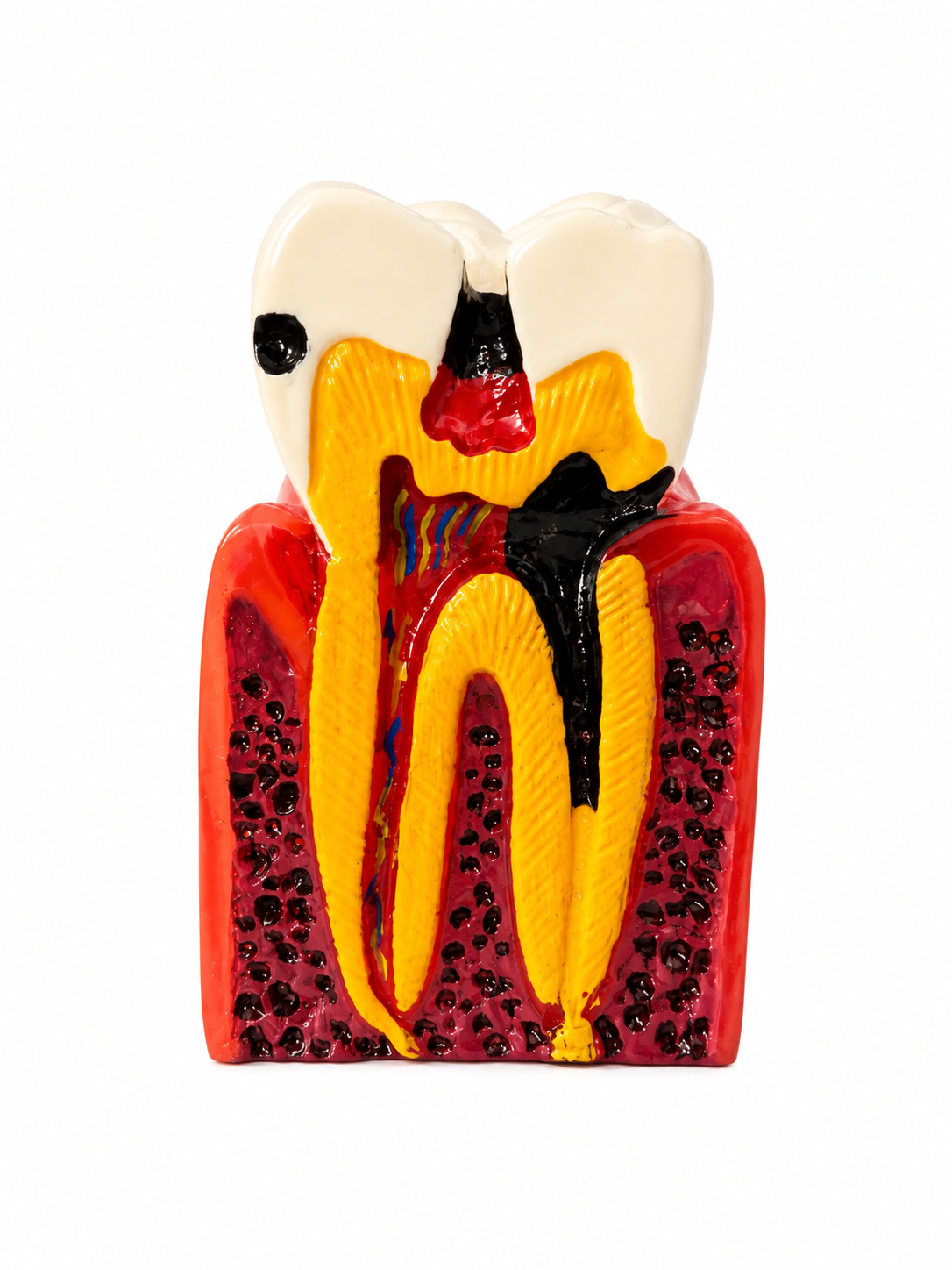 Tooth Decay Dental Model