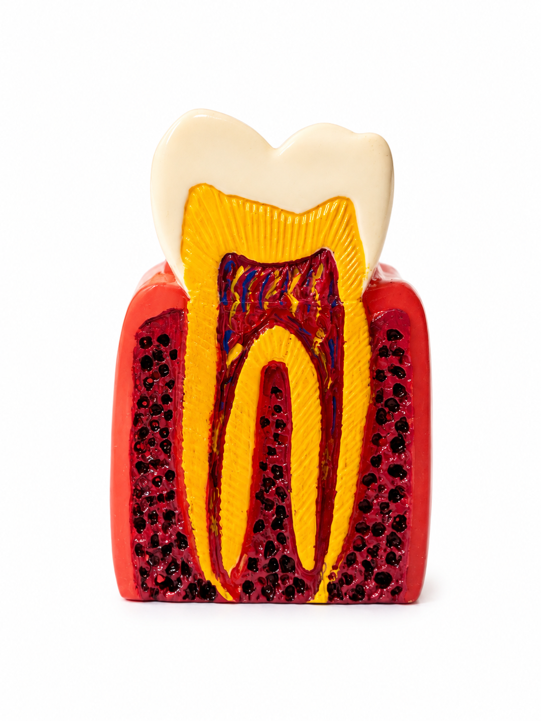 Tooth Decay Dental Model