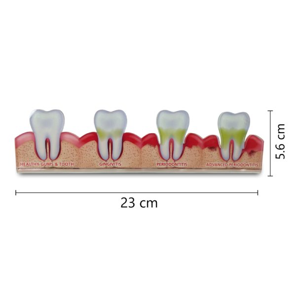 2D Periodontal Disease Progression Model – Healthy to Advanced Stages
