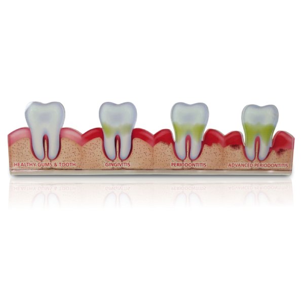 2D Periodontal Disease Progression Model – Healthy to Advanced Stages