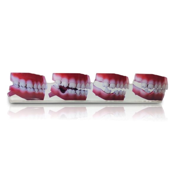 Dental 2D Model – Consequences of Missing Teeth Educational Model