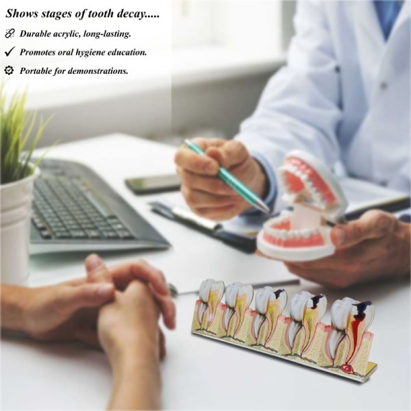 2D Advanced Tooth Decay Model – Enamel to Abscess Formation