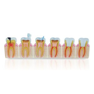 2D Root Canal Treatment Process Model – Step-by-Step Anatomy