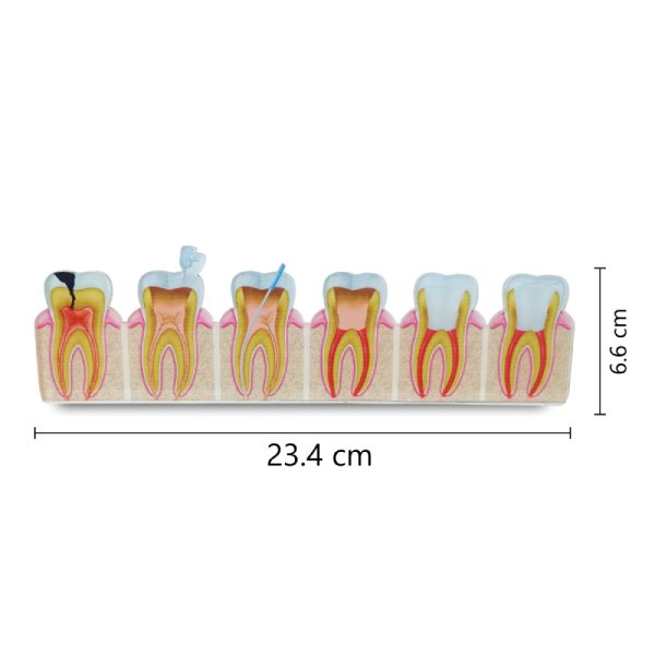 2D Root Canal Treatment Process Model – Step-by-Step Anatomy