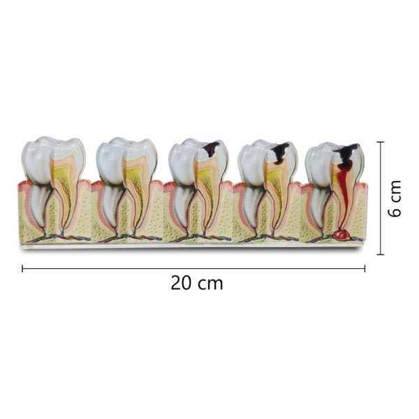 2D Advanced Tooth Decay Model – Enamel to Abscess Formation