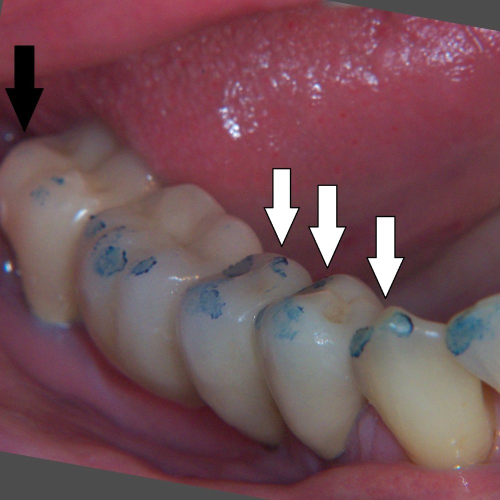 Dental Articulating Paper