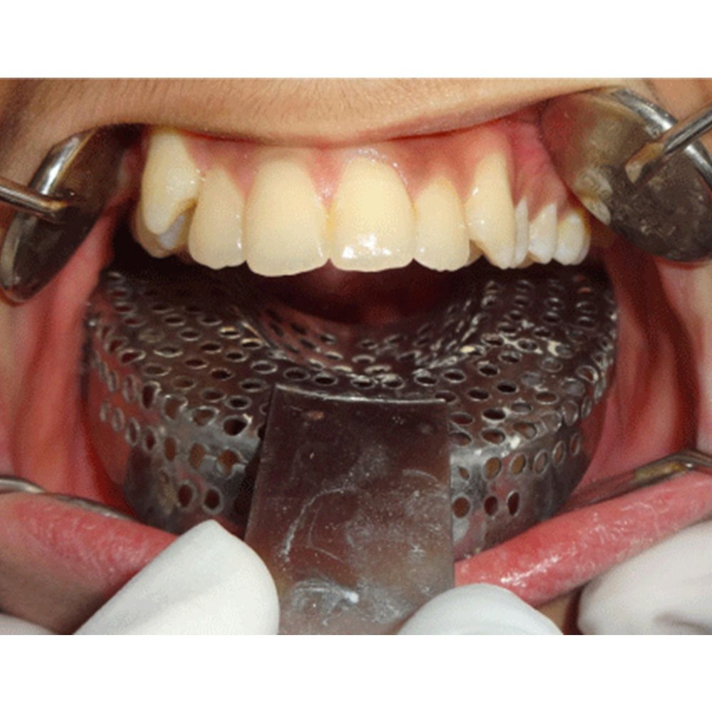 Dental Impression Tray (Dentulous)