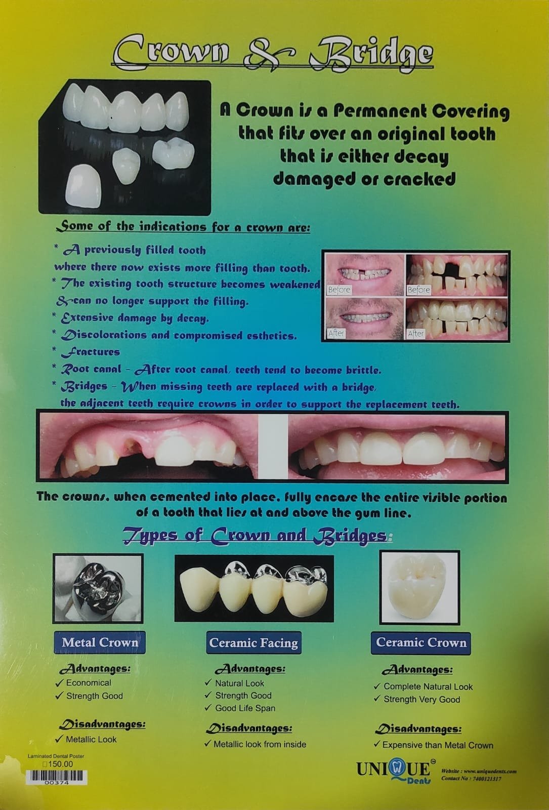 Crown & Bridge – Laminated Poster