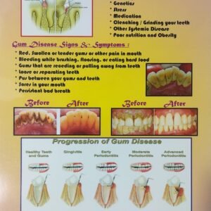 Gum Disease – Laminated Poster