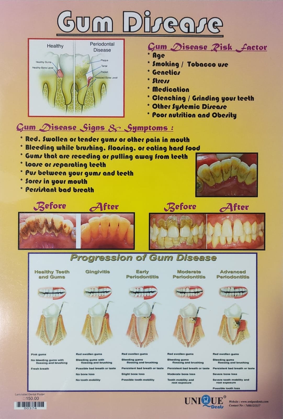 Gum Disease – Laminated Poster